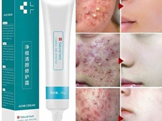20 g de crema antiacné para eliminar cicatrices de acné, gel blanqueador hidratante para el cuidado facial para una piel lisa y suave
